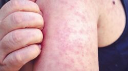 Campak Mulai Menjangkiti Kota Malang, Dinkes Siapkan Imunisasi Massal Campak Mulai Menjangkiti Kota Malang, Dinkes Siapkan Imunisasi Massal