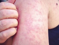 Campak Mulai Menjangkiti Kota Malang, Dinkes Siapkan Imunisasi Massal