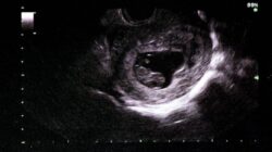 Dua Janin Ditemukan di Septic Tank Apartemen Begawan Malang, Polisi Selidiki Asal Kamar