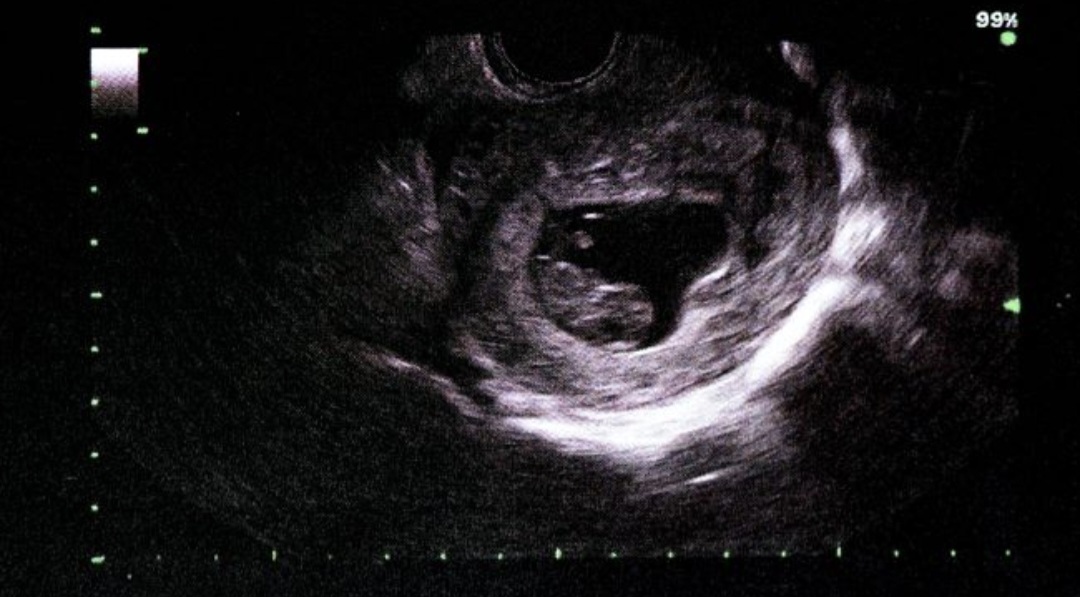 Dua Janin Ditemukan di Septic Tank Apartemen Begawan Malang, Polisi Selidiki Asal Kamar