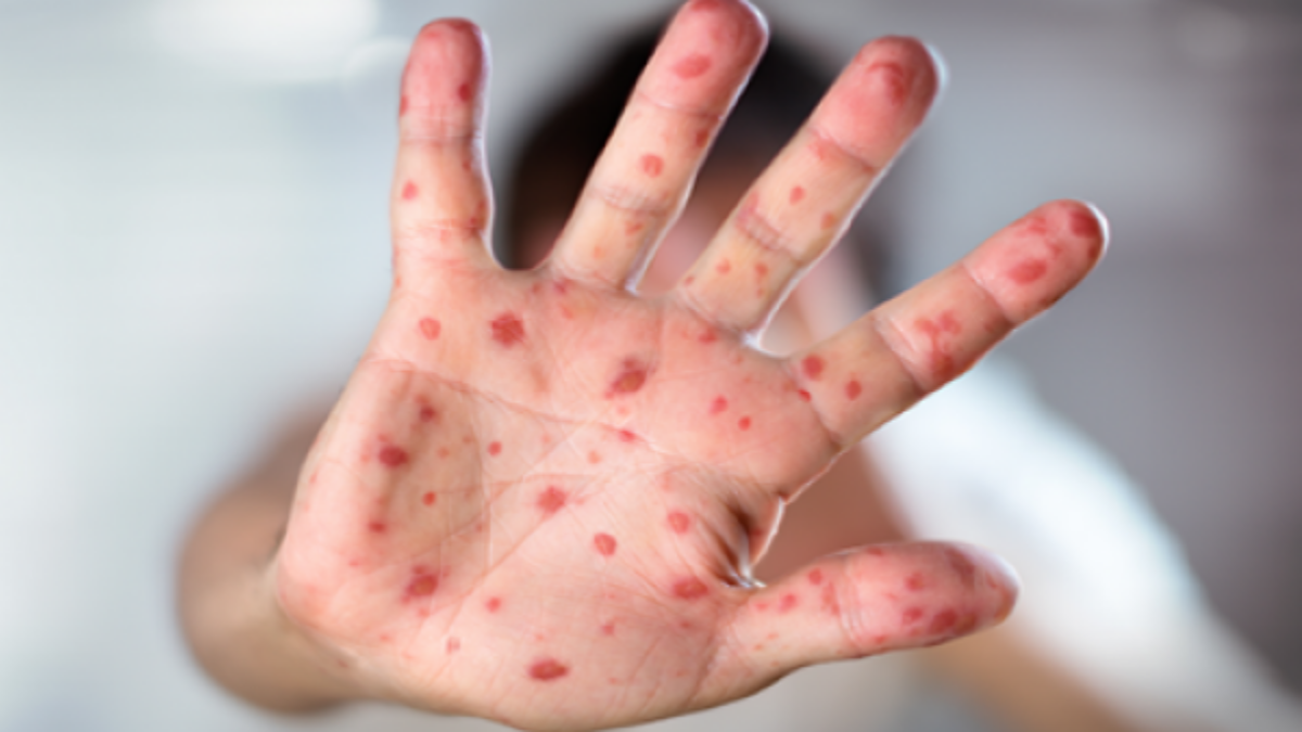 Dinkes Kota Malang Pantau 100 Kasus Suspek Campak, Sampel Dikirim ke BBLK Surabaya