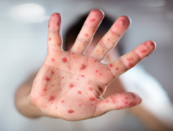 Dinkes Kota Malang Pantau 100 Kasus Suspek Campak, Sampel Dikirim ke BBLK Surabaya