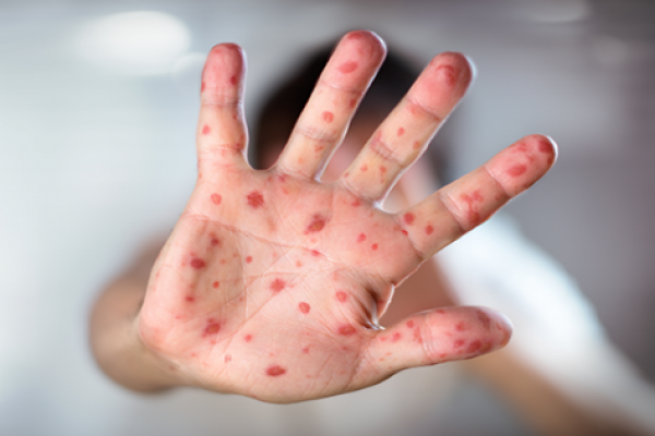 Dinkes Kota Malang Pantau 100 Kasus Suspek Campak, Sampel Dikirim ke BBLK Surabaya